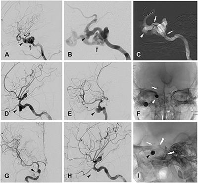 Treatment of Traumatic Intracranial Pseudoaneurysms: A Single-Center Experience